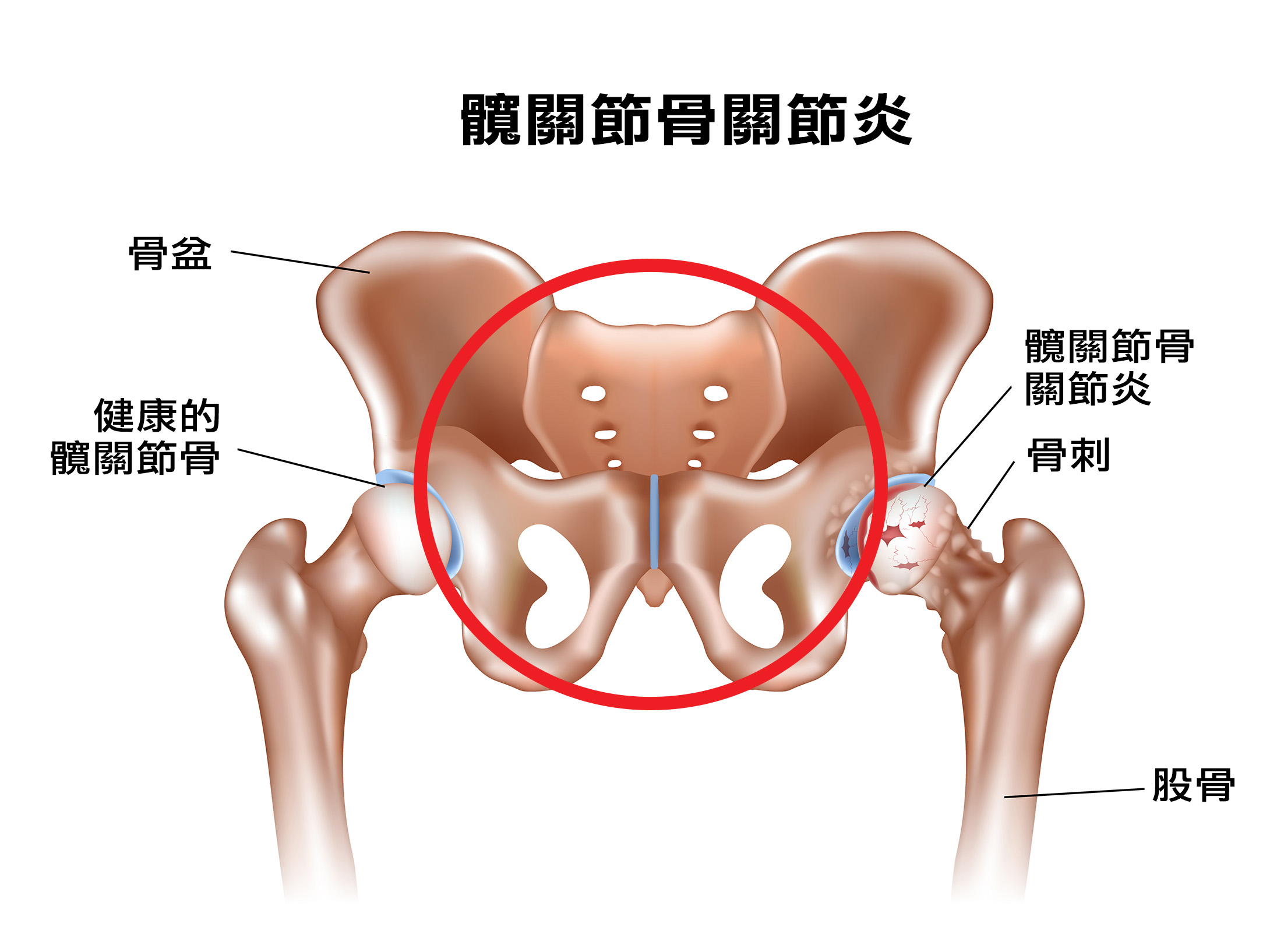 盆腔炎能治愈吗?